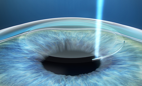 SMILE LASIK LASEK ICL